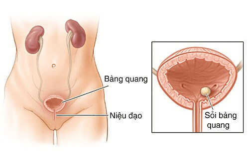 Viêm bàng quang ở nữ 